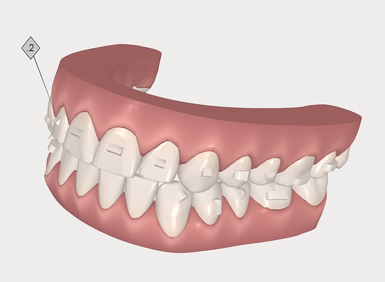 INVISALIGN - 3D behandelingssimulaties